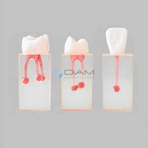 Modelo de diente para tratamiento de endodoncia con coronas y raíz transparente y pared pulpar coloreada