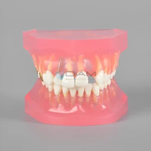 Modelo de tratamiento de comparación de caries antes y después.