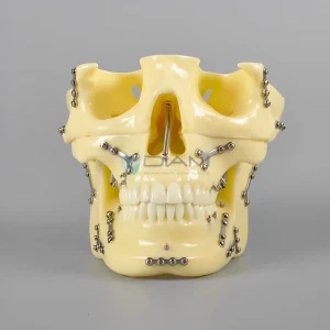 Modelo de cráneo de orto implante