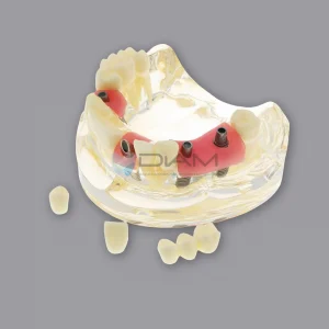 Modelo transparente de raíz normal con implantes