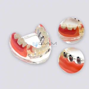 Modelo de implante de prótesis dental