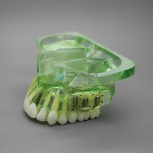 Modelo de implante de maxilar superior