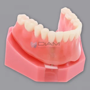 Modelo de demostración de sobre dentadura mandibular con 2 Implantes