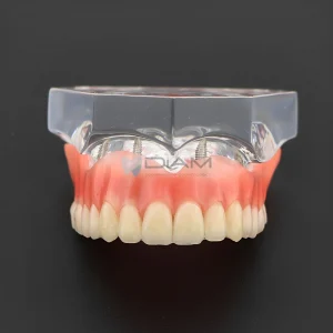 Modelo de demostración transparente de sobre dentadura maxilar para demostración mandibular con 4 implantes