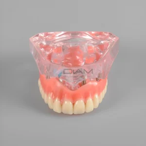 Modelo de demostración transparente color rojo de sobre dentadura maxilar para demostración mandibular con 4 implantes