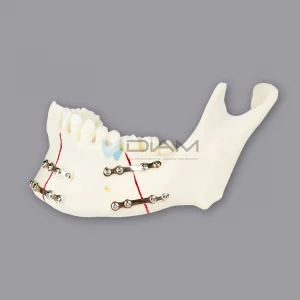 Modelo de demostración de fractura mandibular tratada con placa de titanio.