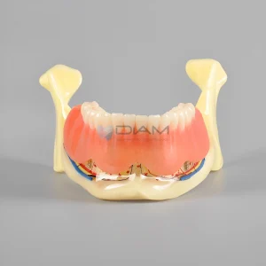 Modelo de demostración de sobre dentadura mandibular con 4 Implantes