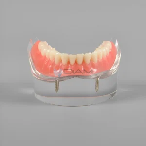 Modelo de demostración transparente de sobre dentadura mandibular con 2 implantes