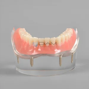 Modelo de demostración transparente de sobre dentadura mandibular con 4 Implantes