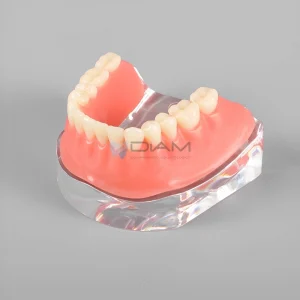 Modelo de demostración transparente de sobre dentadura mandibular con 4 implantes y barra de plata