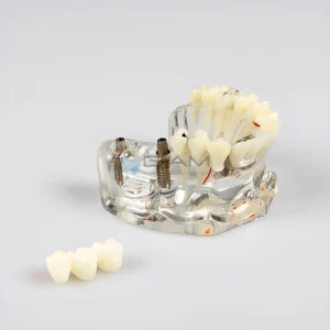 Modelo de demostración de implante dental con restauración y caries.