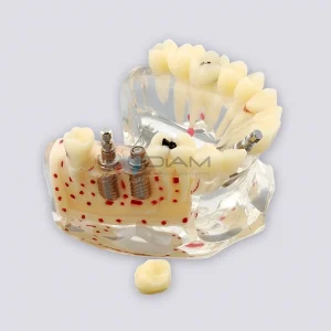 Modelo de implante dental con caries, fractura radicular y relación con el hueso.