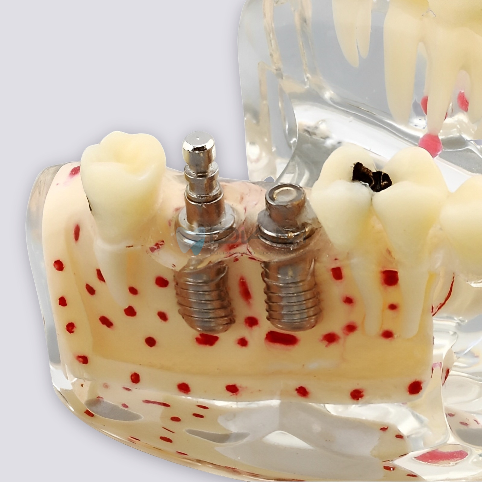 Modelo de implante dental con caries, fractura radicular y relación con el hueso. - Imagen 2