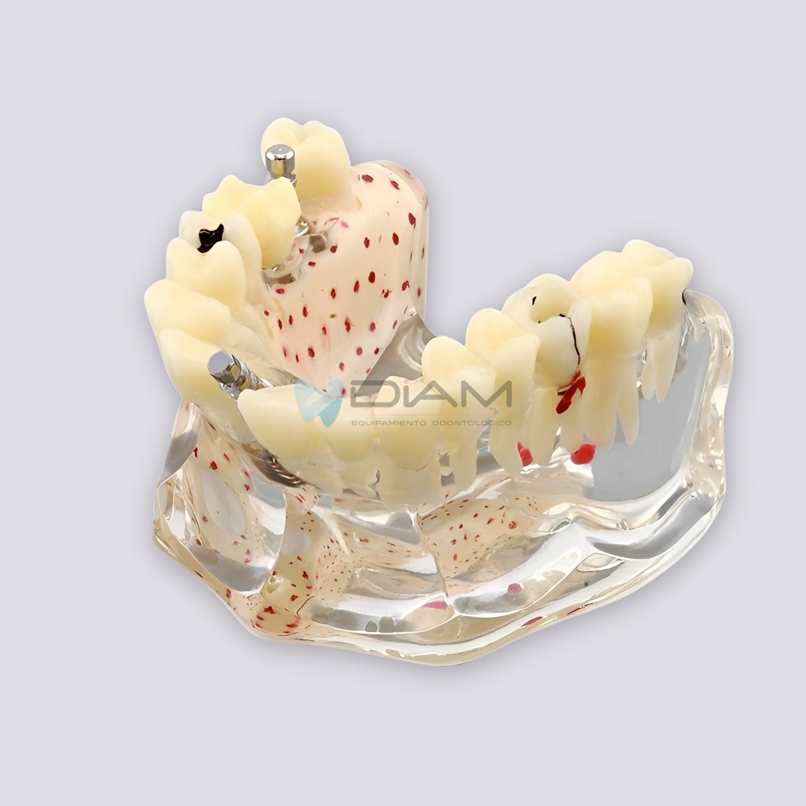 Modelo de implante dental con caries, fractura radicular y relación con el hueso. - Imagen 3