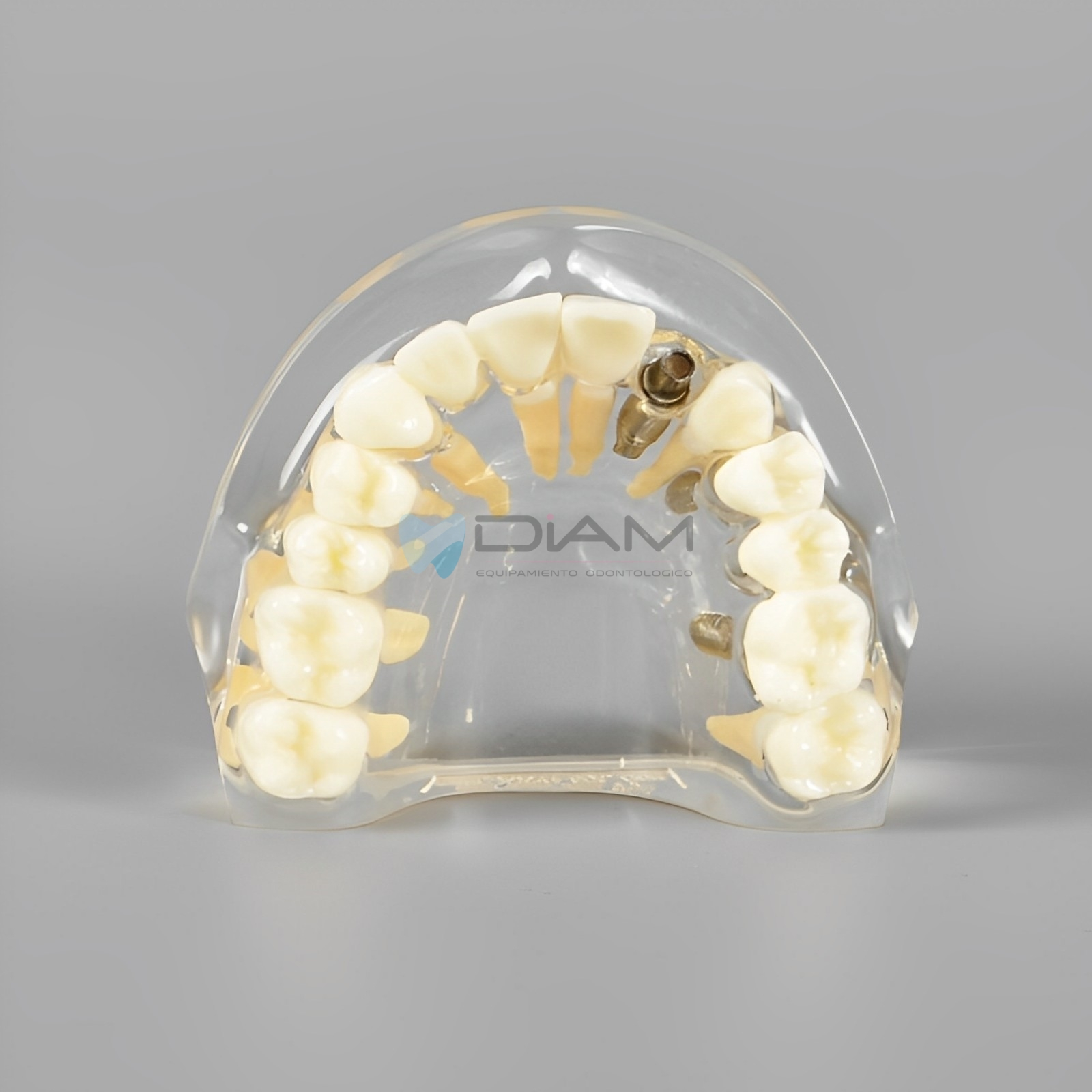 Modelo de implante dental para visualización de implantes, pilares, coronas y puentes.