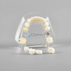 Modelo de Implante dental con dientes naturales en la mandíbula.