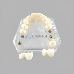 Modelo maxilar con implante y corona de material transparente.