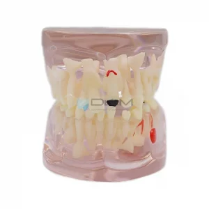 Modelo transparente de edad mixta con caries