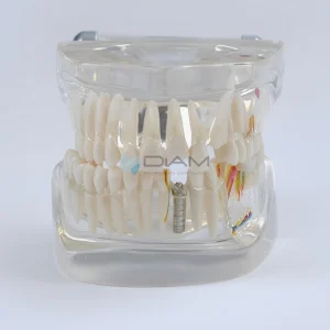 Modelo patológico transparente de edad mixta con caries