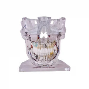 Modelo transparente patológico con nervio
