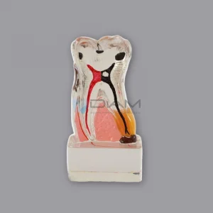 Diente transparente con enfermedad periodontal 4 veces su tamaño