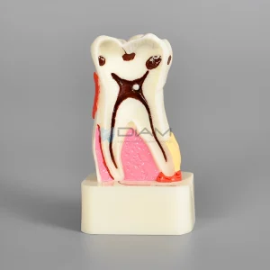 Modelo patológico con enfermedad periodontal diente 4 veces su tamaño