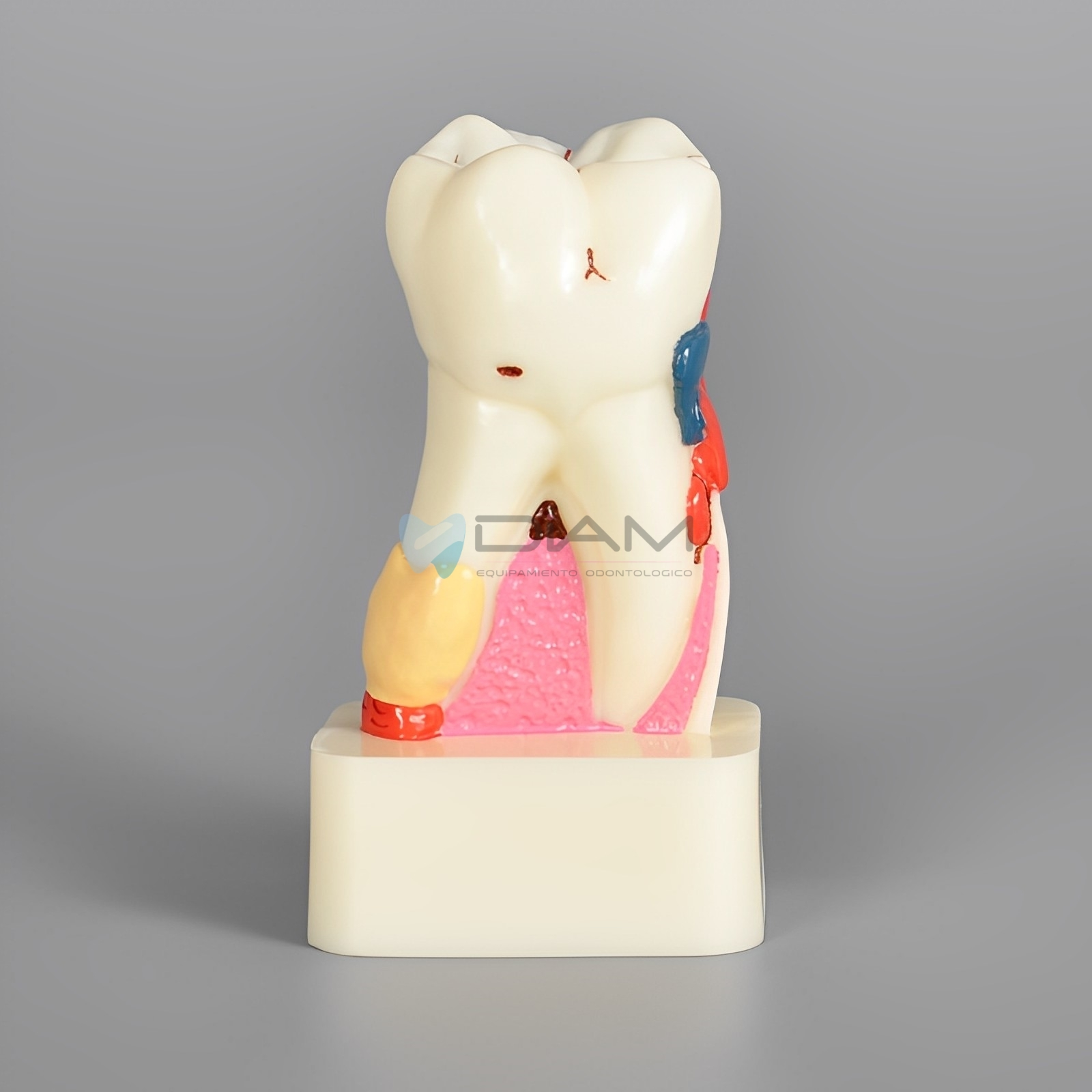 Modelo patológico con enfermedad periodontal diente 4 veces su tamaño - Imagen 2