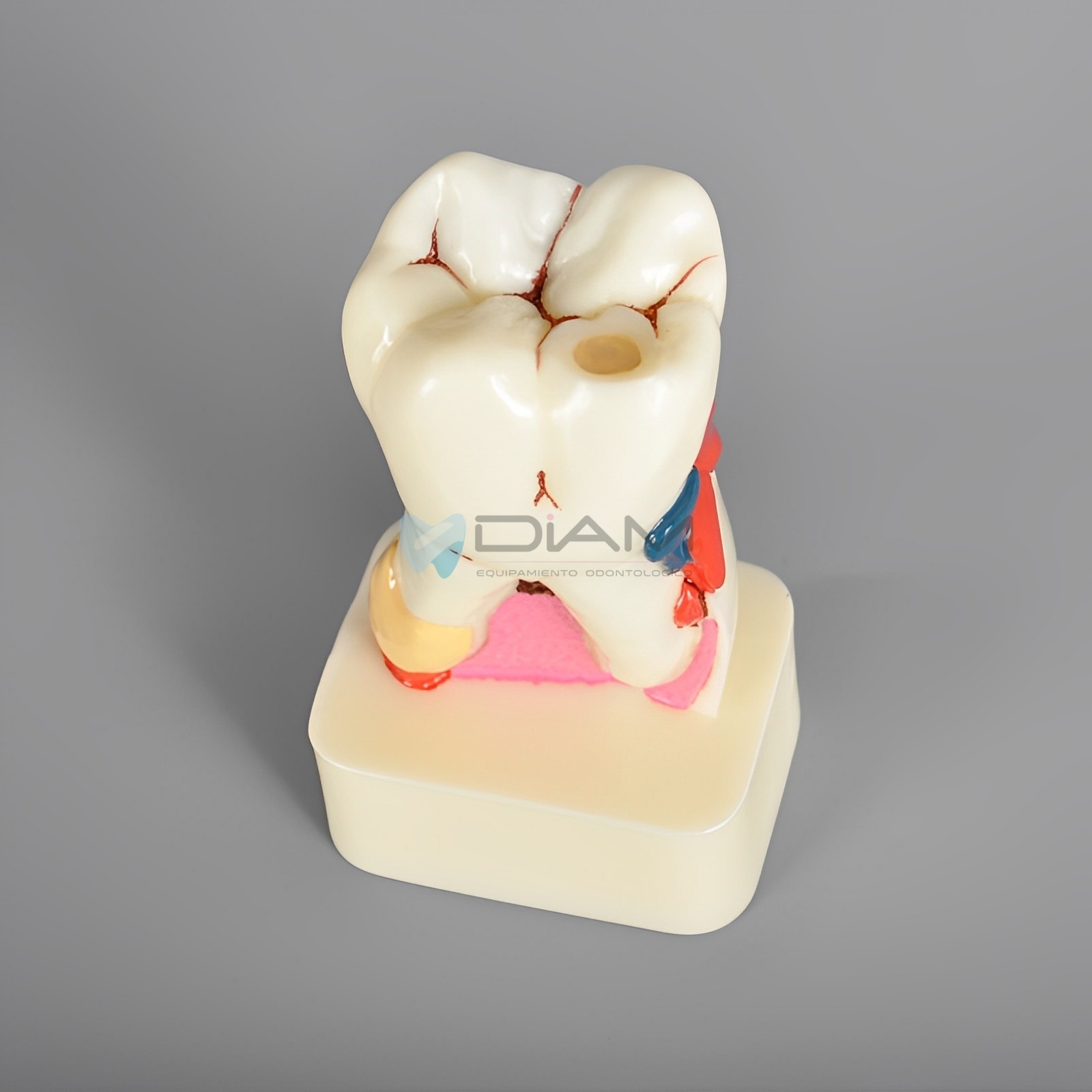 Modelo patológico con enfermedad periodontal diente 4 veces su tamaño - Imagen 4