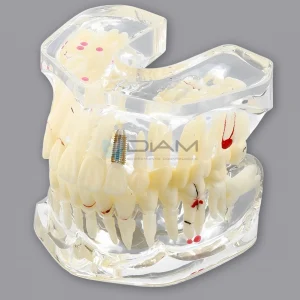 Modelo patológico que muestra diferentes patologías dentales.