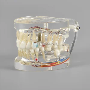 Modelo patológico con nervio, caries y implantes