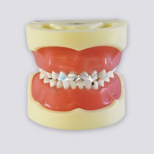 Modelo estándar de caries infantil