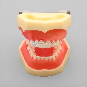 Modelo de enfermedad periodontal muestra una recesión gingival en el lado derecho