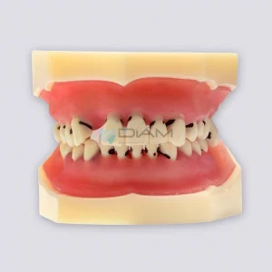 Modelo de enfermedad periodontal muestra la reabsorción ósea y el cálculo subgingival