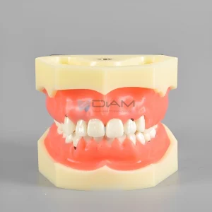 Modelo de enfermedad periodontal con gingivitis y pérdida ósea