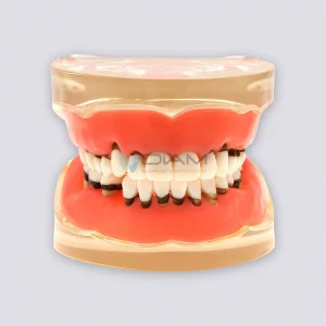 Modelo de enfermedad periodontal con sarro, recesión gingival y encías saludables