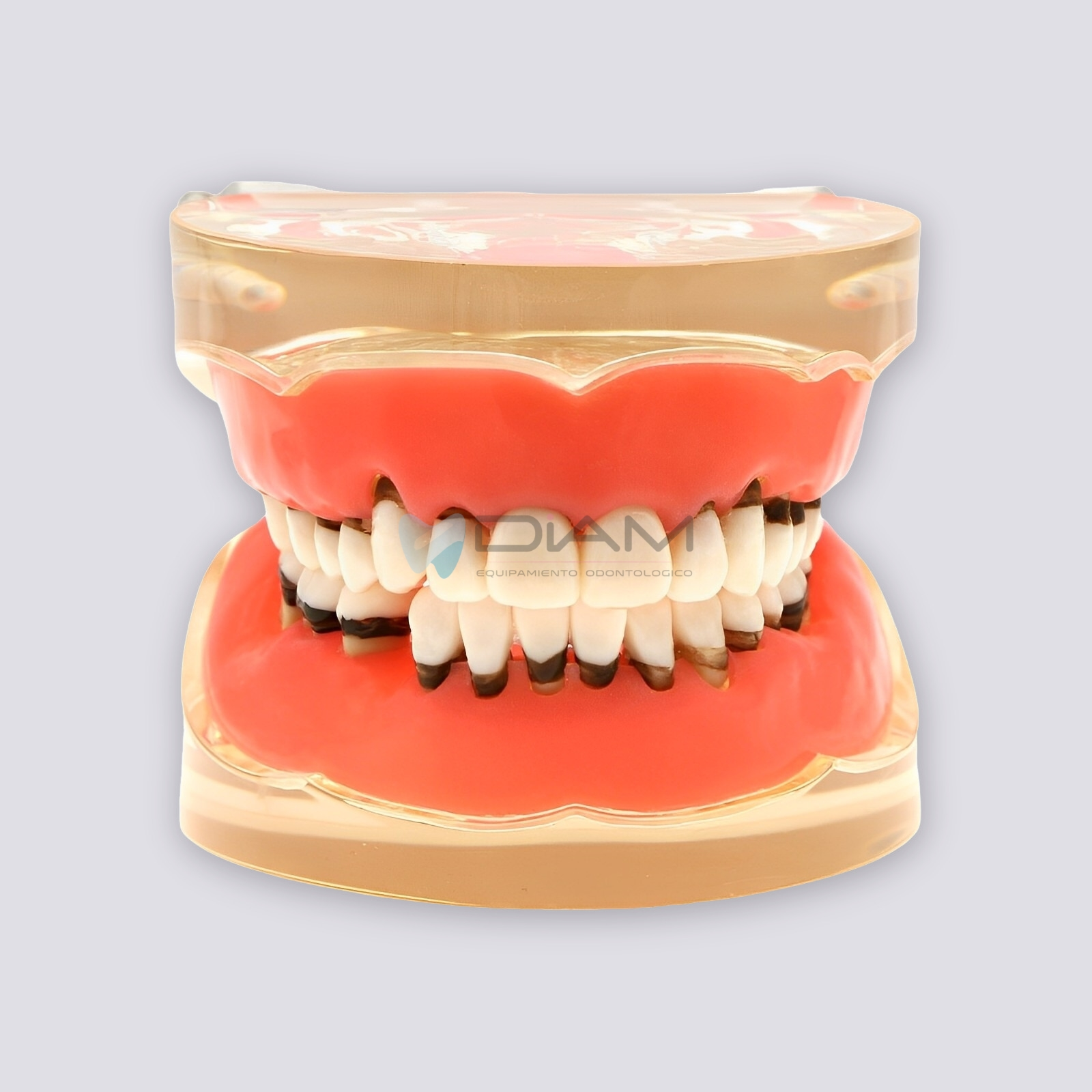 Modelo de enfermedad periodontal con sarro, recesión gingival y encías saludables