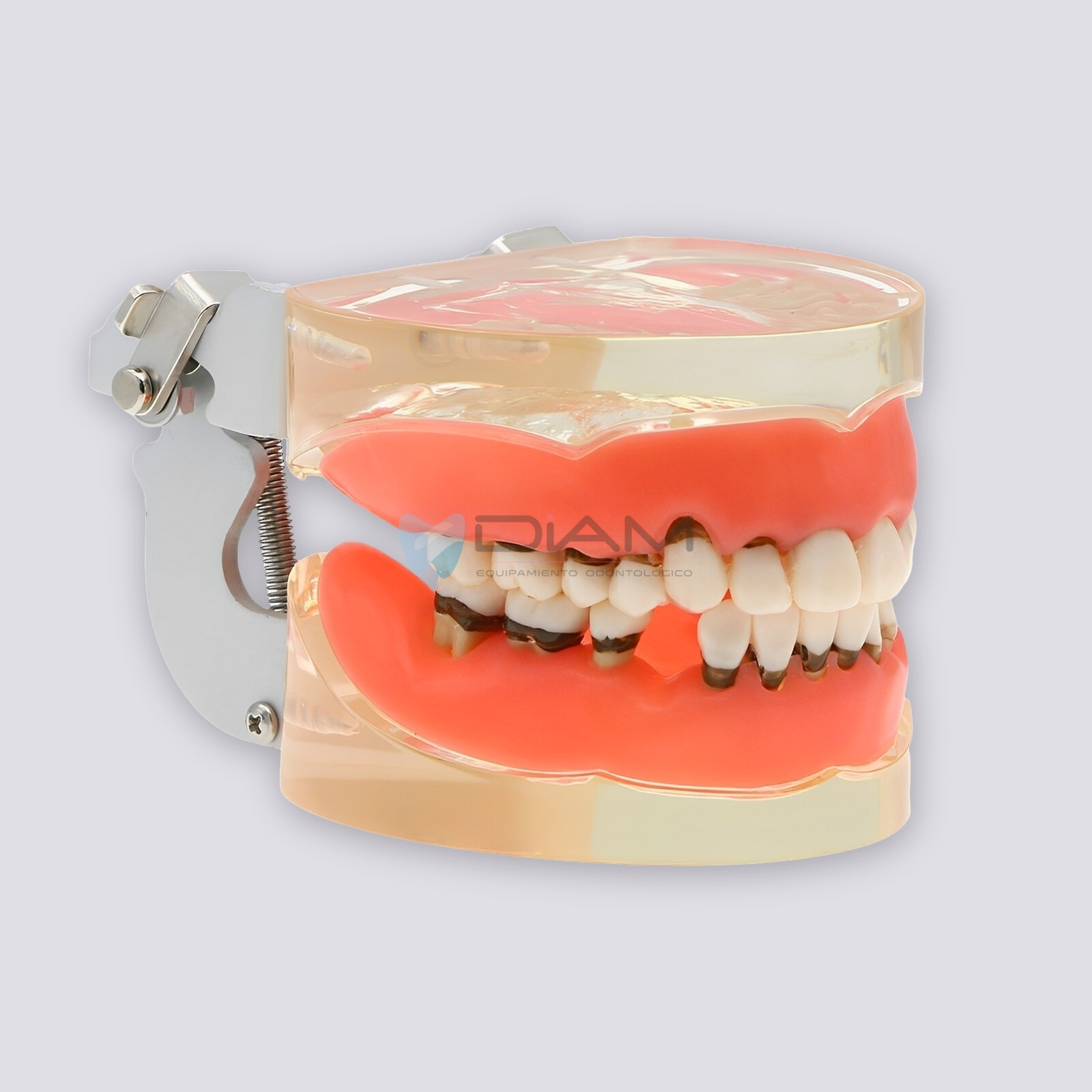 Modelo de enfermedad periodontal con sarro, recesión gingival y encías saludables - Imagen 2