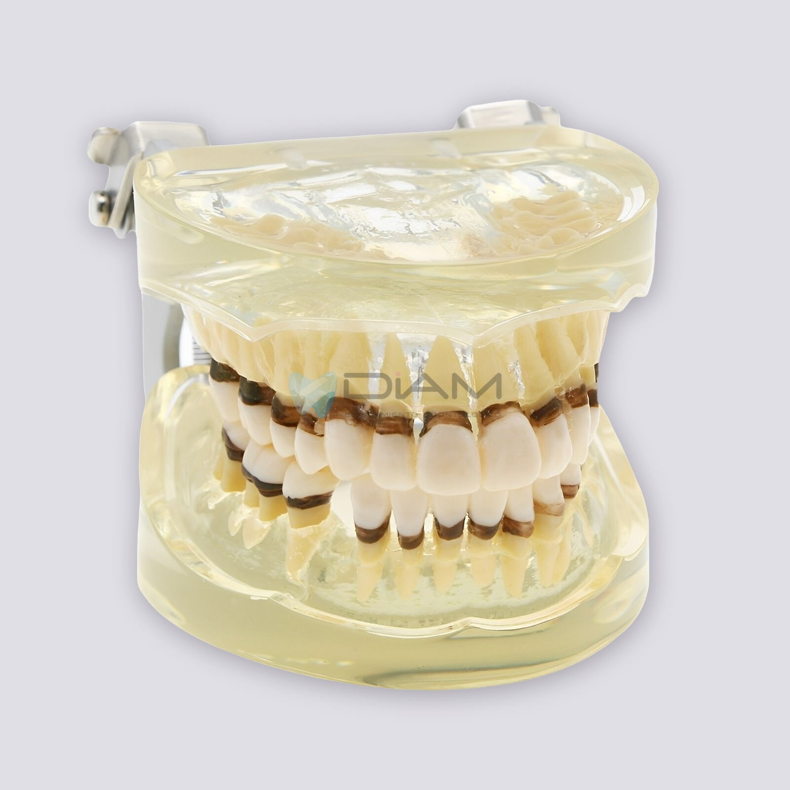 Modelo de enfermedad periodontal con sarro, recesión gingival y encías saludables - Imagen 5