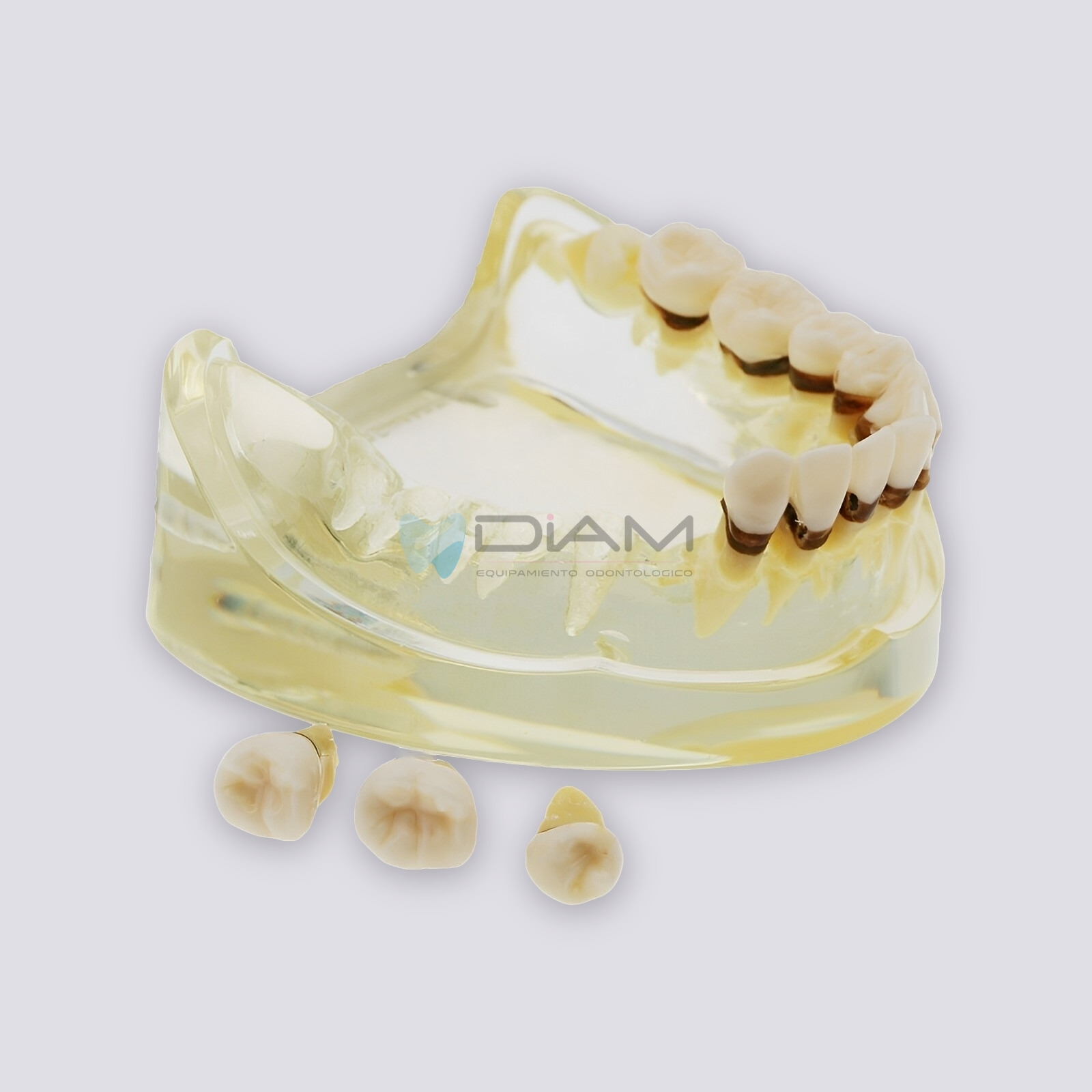 Modelo de enfermedad periodontal con sarro, recesión gingival y encías saludables - Imagen 6
