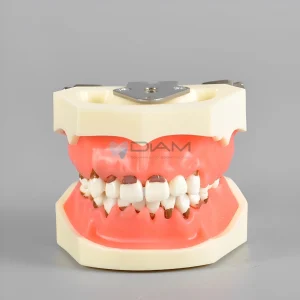 Modelo de enfermedad periodontal. Encías con inflamación severa y cálculo dental