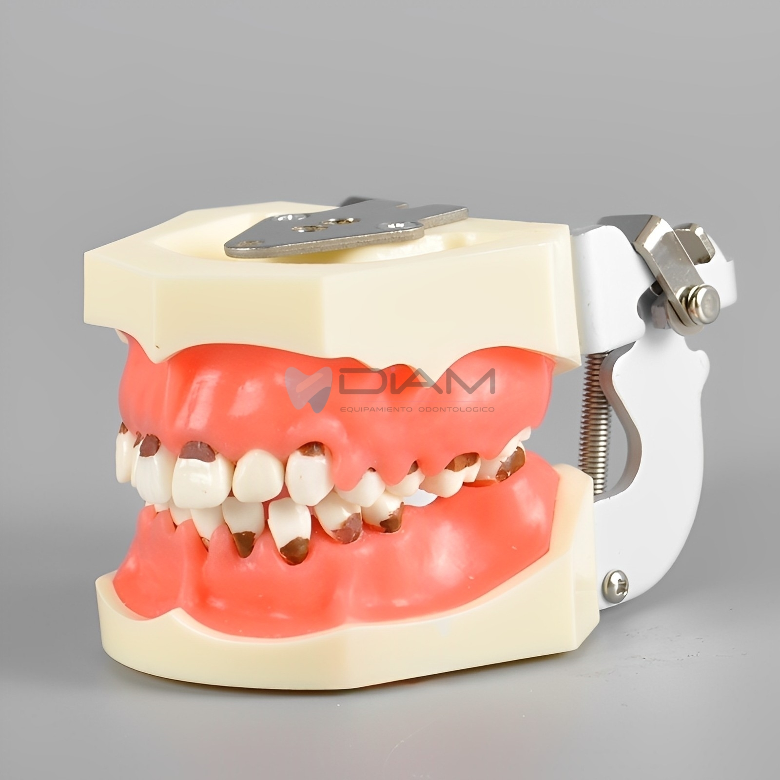Modelo de enfermedad periodontal. Encías con inflamación severa y cálculo dental - Imagen 2