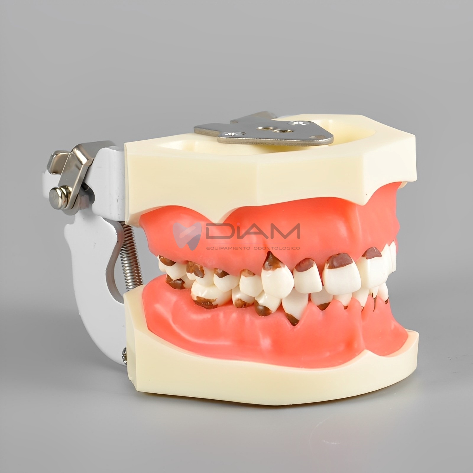 Modelo de enfermedad periodontal. Encías con inflamación severa y cálculo dental - Imagen 3