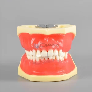 Modelo de enfermedad periodontal muestra diagnóstico y tratamiento de afecciones como el cálculo dental y la gingivitis.