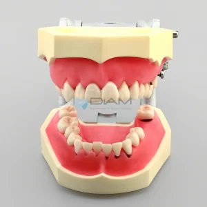 Modelo de enfermedad periodontal con encías severamente inflamadas con cálculo y encías duras