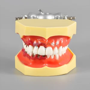 Modelo de enfermedad periodontal con recesión del cálculo gingival y gingivitis.