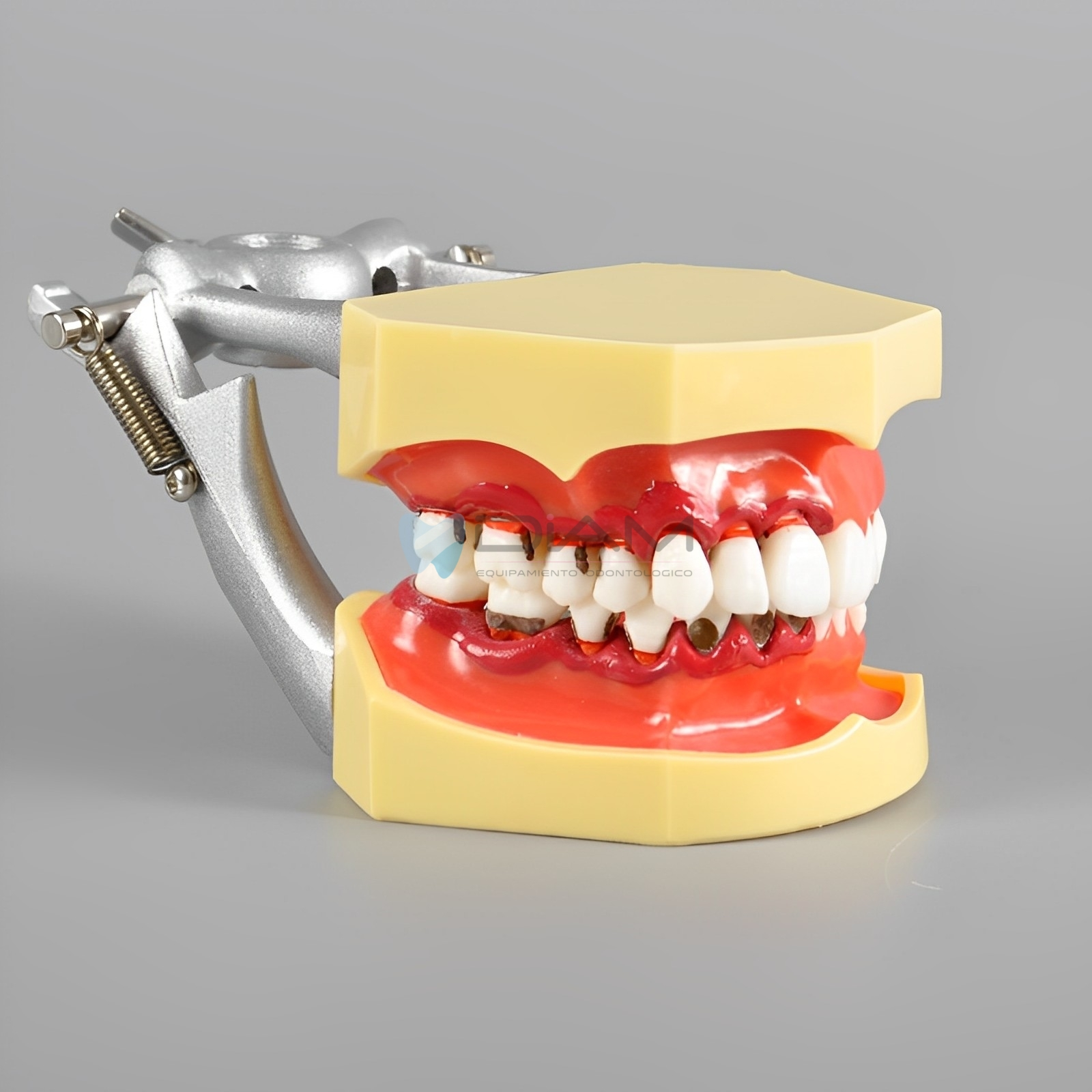 Modelo de enfermedad periodontal con recesión del cálculo gingival y gingivitis. - Imagen 3