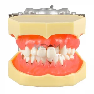 Modelo de enfermedad periodontal con encías gravemente inflamadas con cálculos y encía dura.