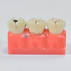 Modelo de demostración 3 fases de las caries. Modelo desmontable 4 veces su tamaño