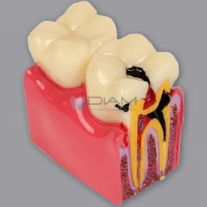 Modelo de comparación de caries. 6 veces su tamaño
