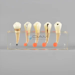 Modelo de demostración clínico de enfermedad de la pulpa dental. 5 fases del tratamiento de curación de la endodoncia